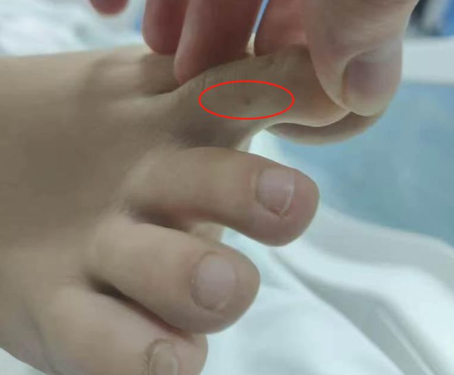 “三亞旅游被不明物咬傷身亡27歲女子”死亡記錄:曾診斷為不明生物咬傷(神經毒蛇) 等(圖2)