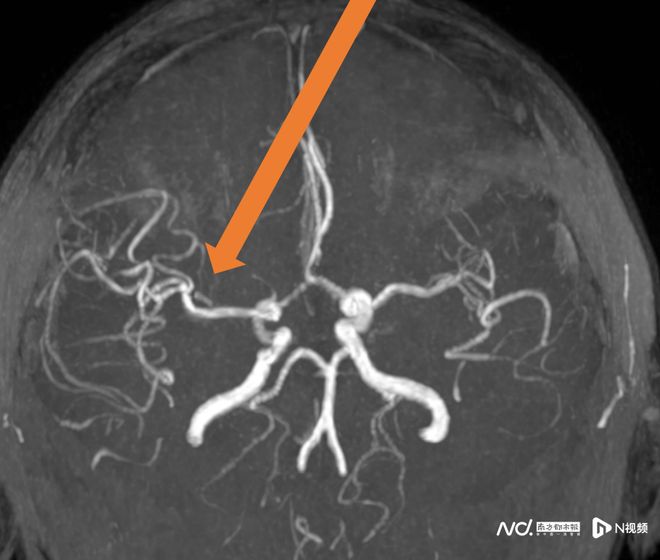 卒中發病呈現年輕化趨勢這個放松動作可能“按”出腦卒中(圖4)