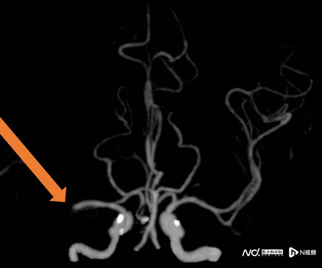 卒中發病呈現年輕化趨勢這個放松動作可能“按”出腦卒中(圖3)