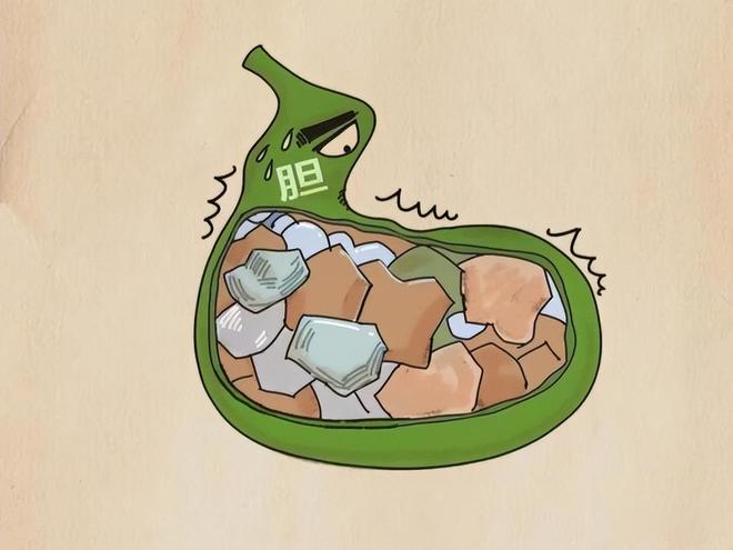 反胃?消化不良?不要硬扛!小心膽結石及時就醫別拖延(圖4)