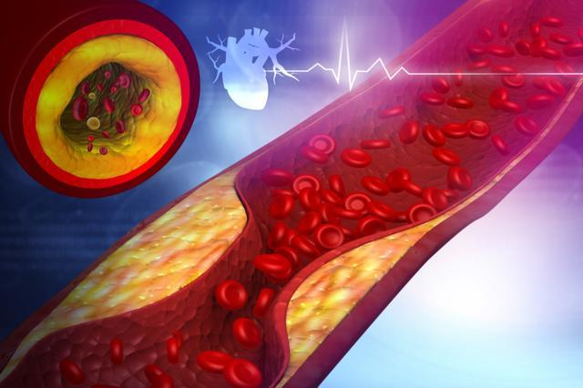 腿部是心梗的放大鏡?忠告:腿部出現這幾種表現盡快就醫!(圖2)
